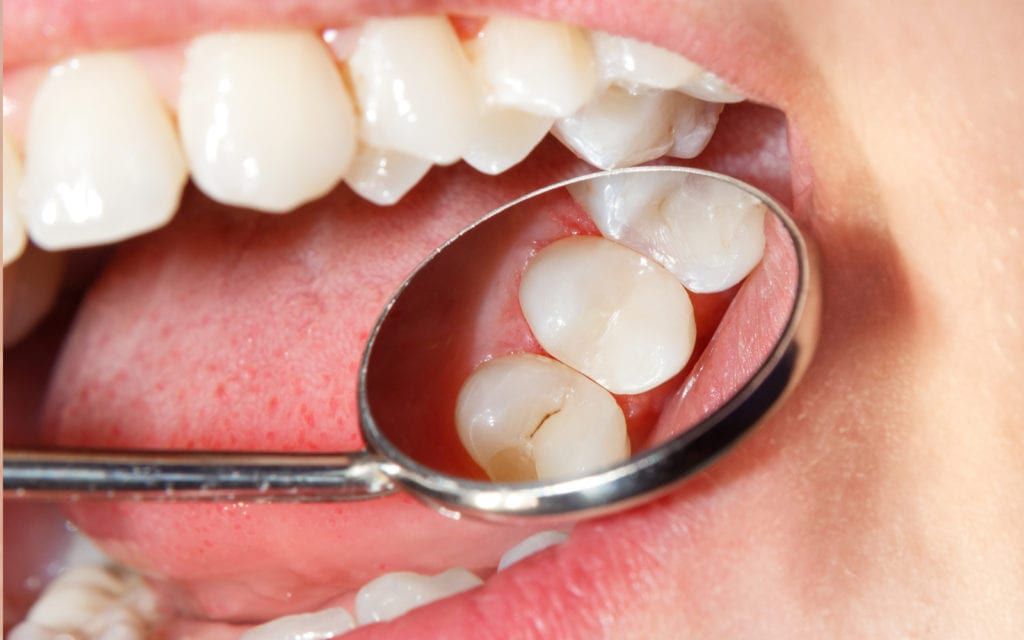 composite fillings in kitchener