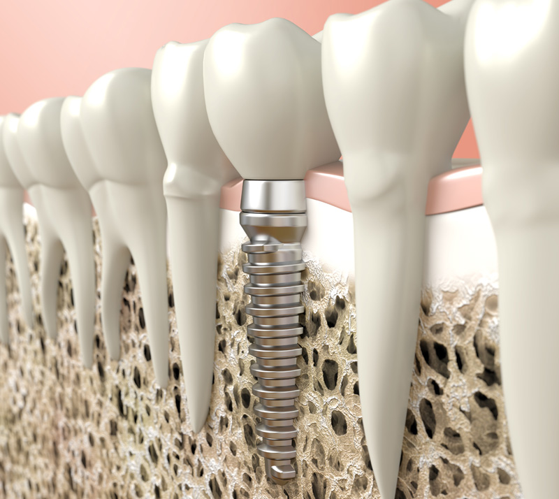 dental implants in kitchener