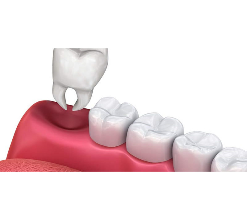 tooth extractions in kitchener