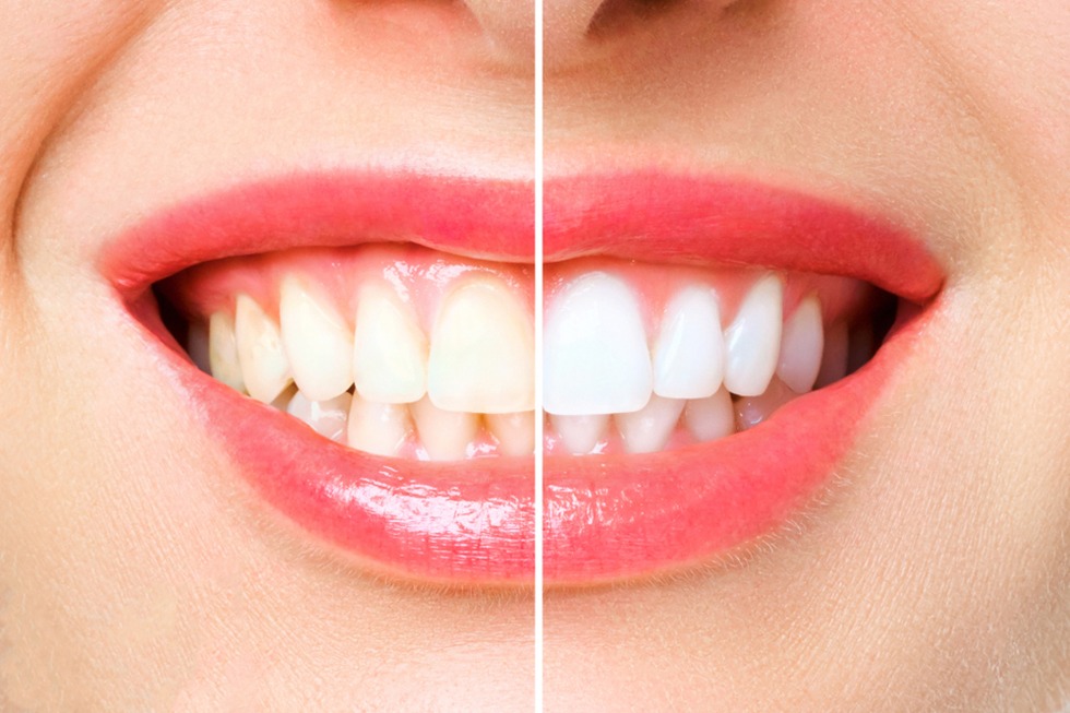 A Closer Look at Teeth Whitening Trends